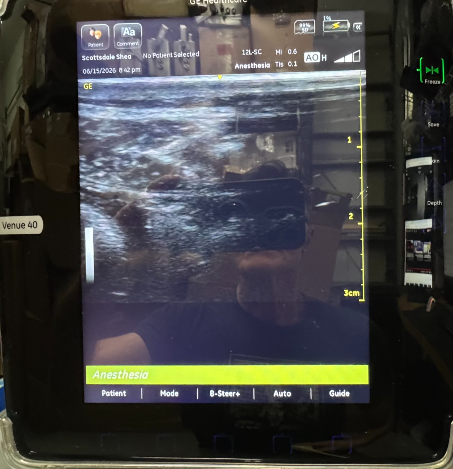 GE Venue 40 Portable Ultrasound Machine 5418778 With 12L-SC Transducer